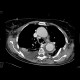 Aneurysm of the thoracic aorta, circular thrombosis: CT - Computed tomography